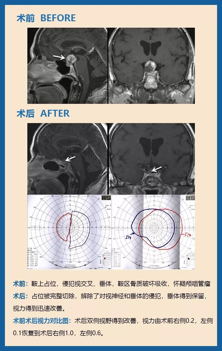 顱咽管瘤可以微創(chuàng)手術嗎？圖片
