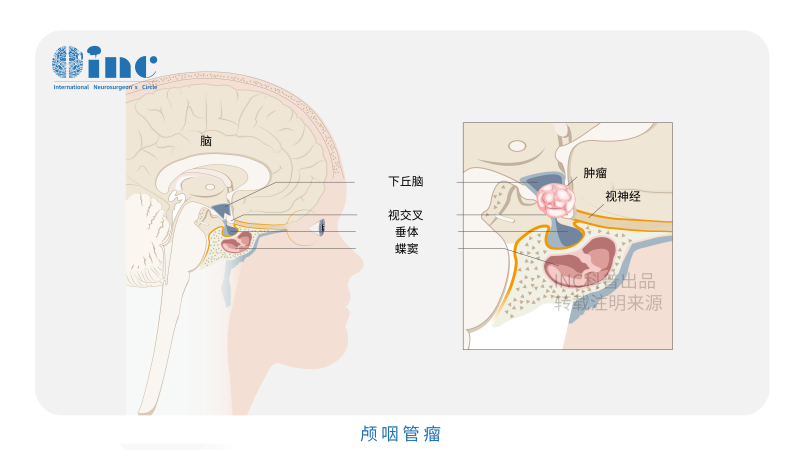 顱咽管瘤術(shù)后并發(fā)癥有哪些？