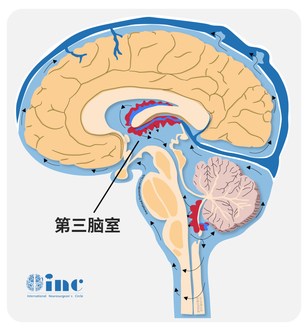 腦室海綿狀血管瘤圖片