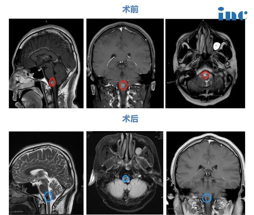 延髓海綿狀血管瘤嚴(yán)重嗎案例