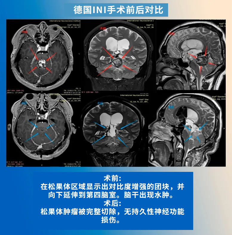 松果體區(qū)腫瘤手術(shù)案例對比