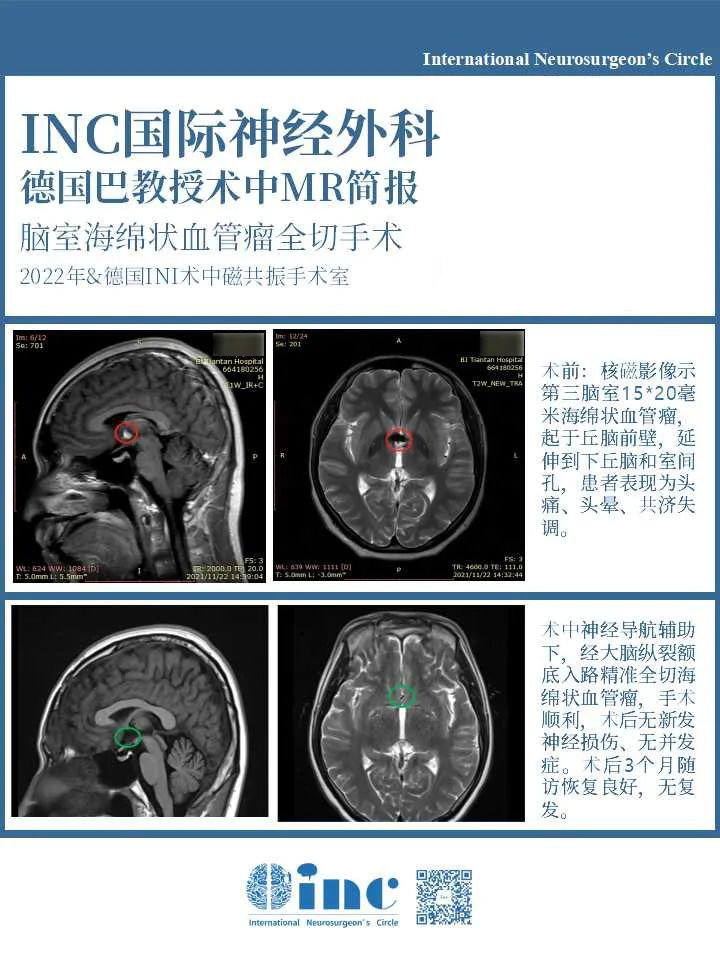 海綿狀血管瘤怎么治