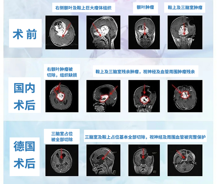 兒童視神經(jīng)膠質(zhì)瘤能治好嗎？案例