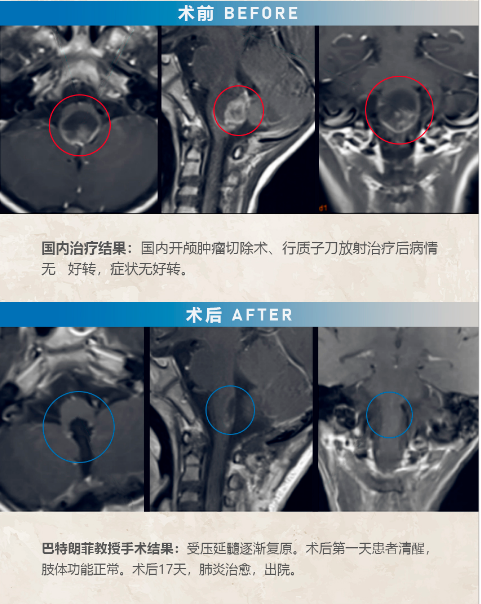 四腦室腫瘤手術(shù)