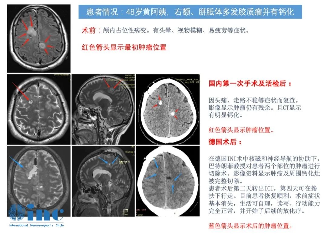膠質(zhì)瘤復(fù)發(fā)