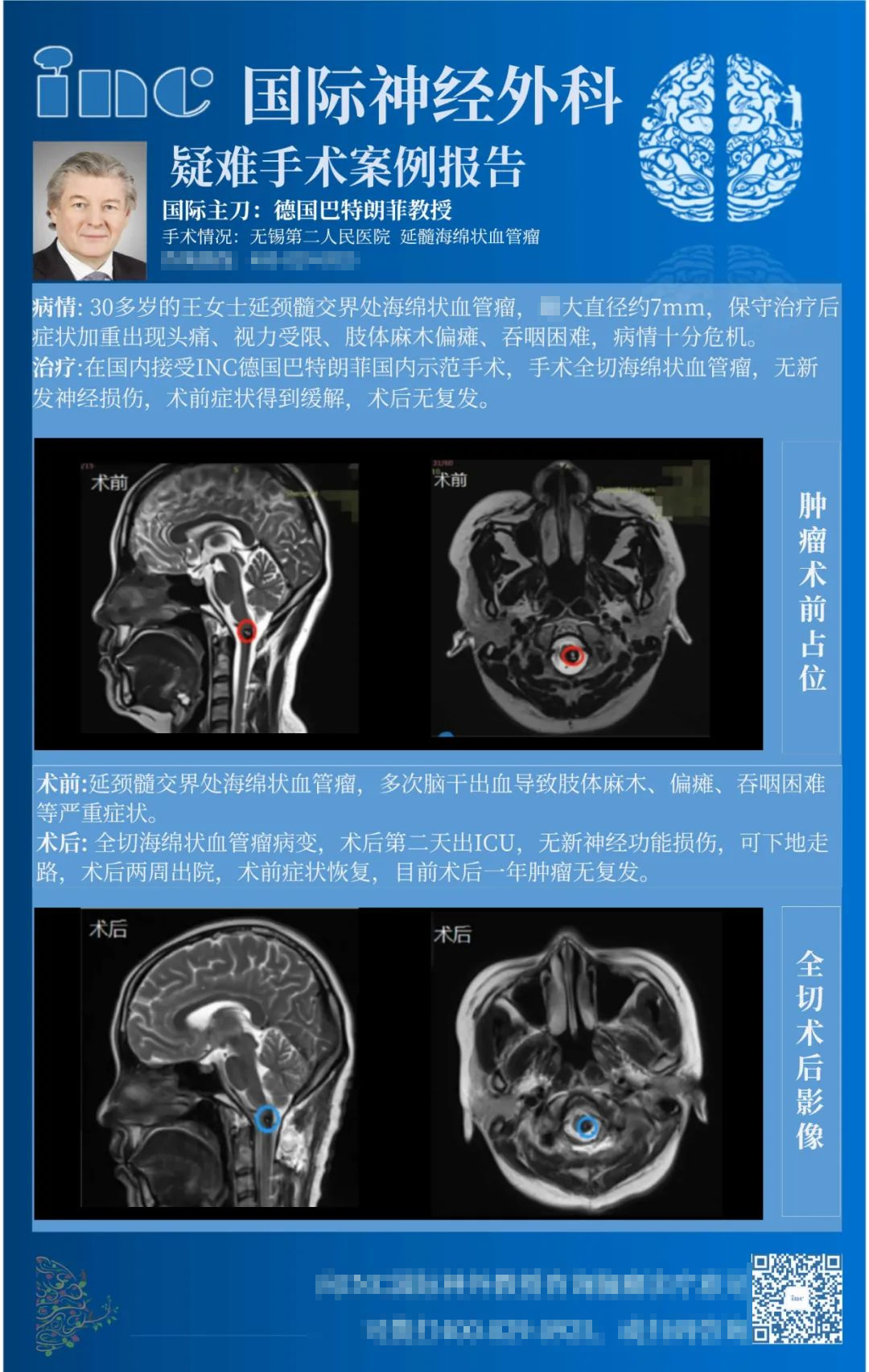 海綿狀血管瘤手術(shù)案例