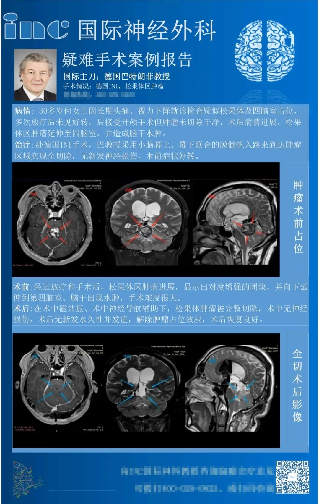 較大松果體區(qū)腫瘤