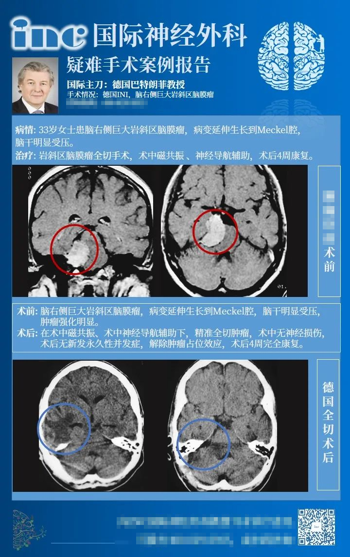 巖斜區(qū)腦膜瘤