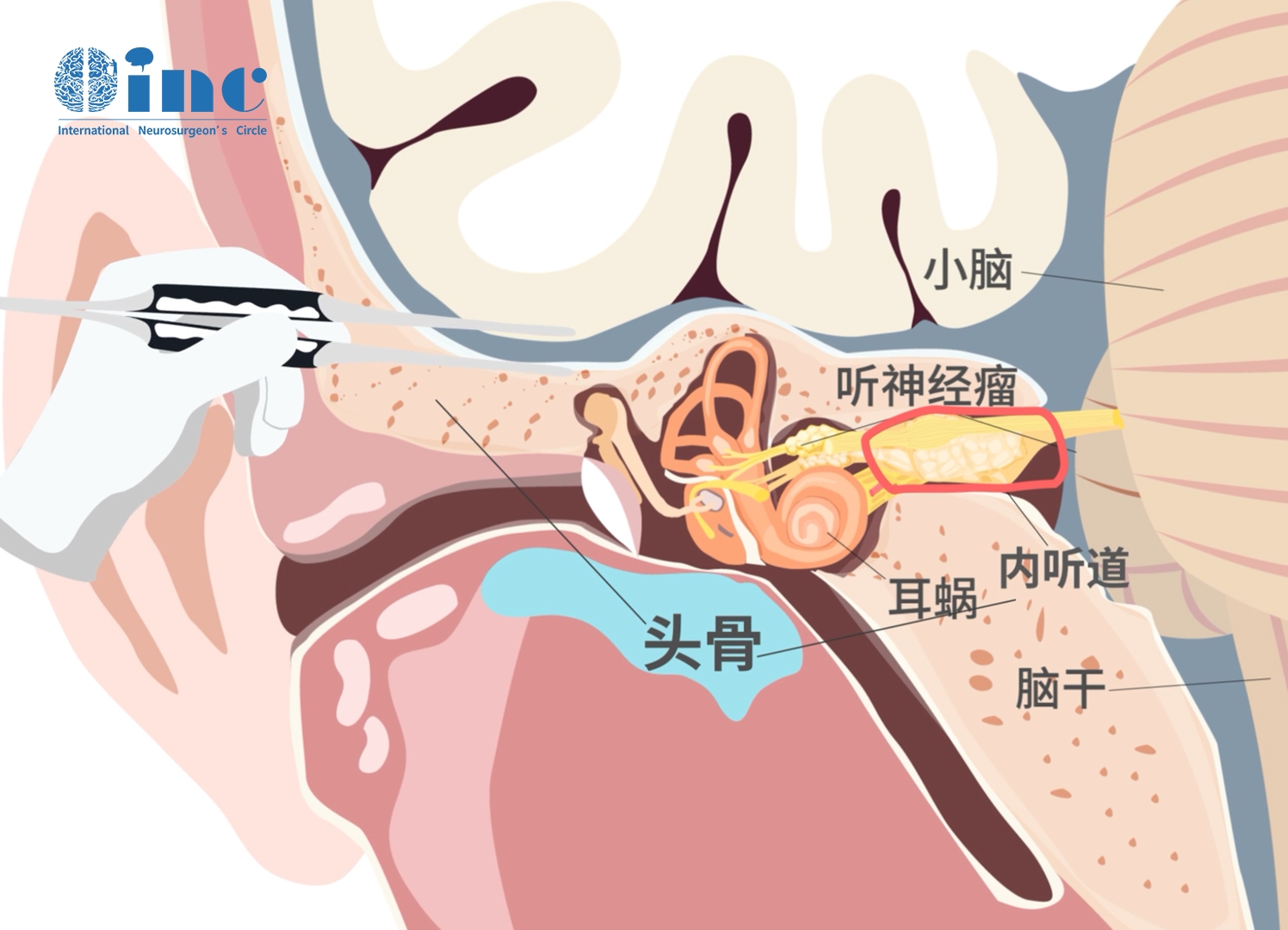 聽神經(jīng)瘤手術(shù)