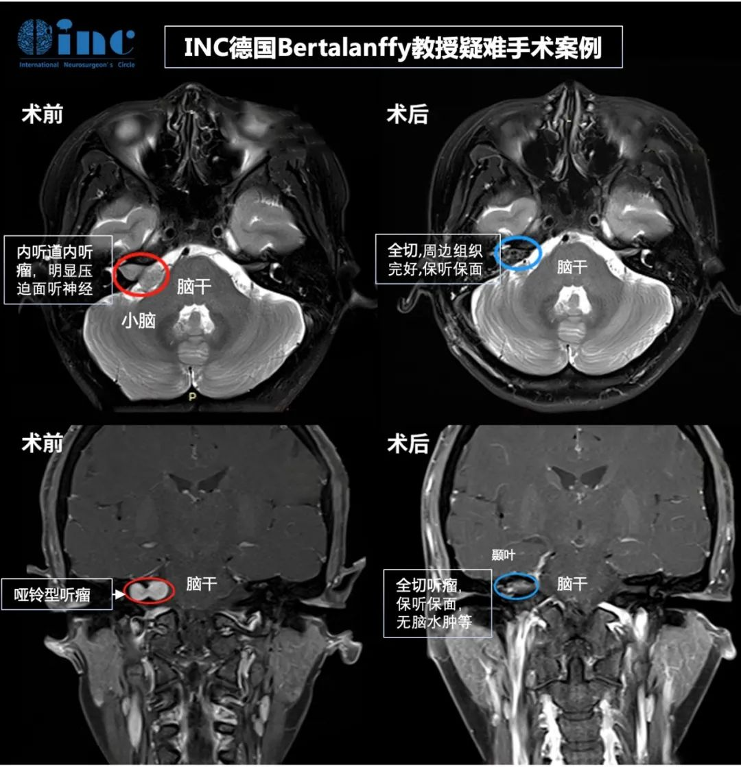 聽神經(jīng)瘤案例