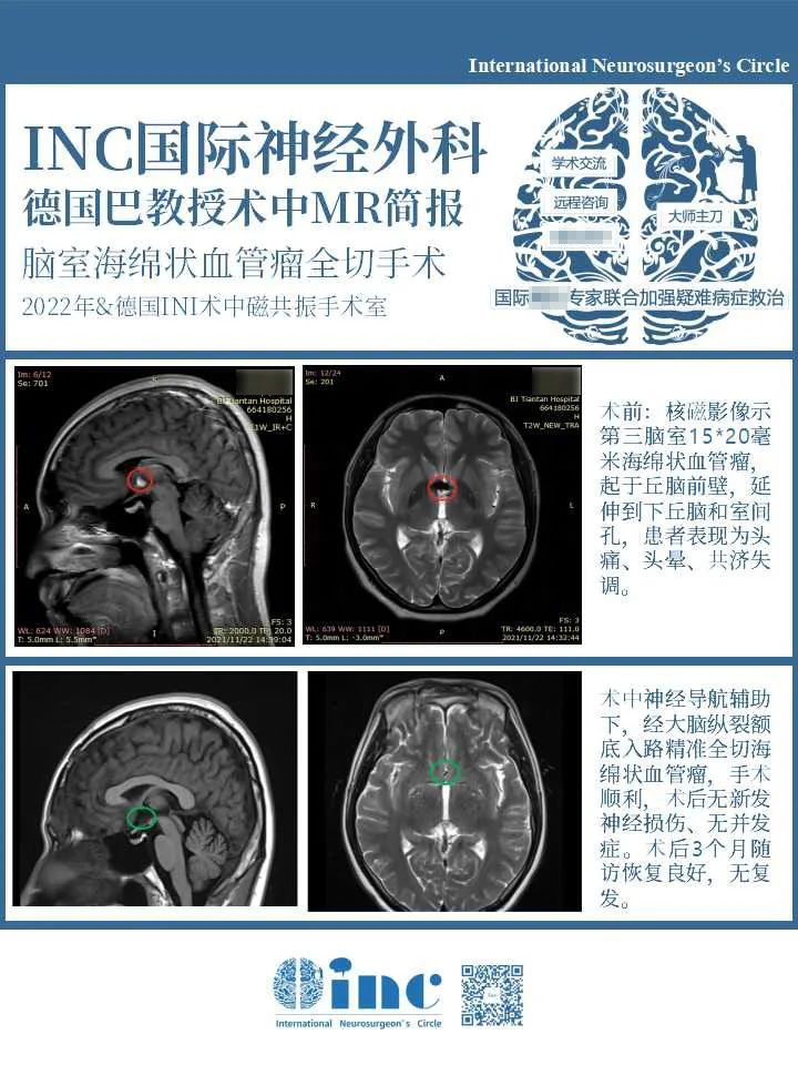 腦室內(nèi)海綿狀血管瘤手術(shù)案例