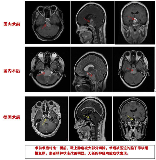 脊索瘤手術(shù)