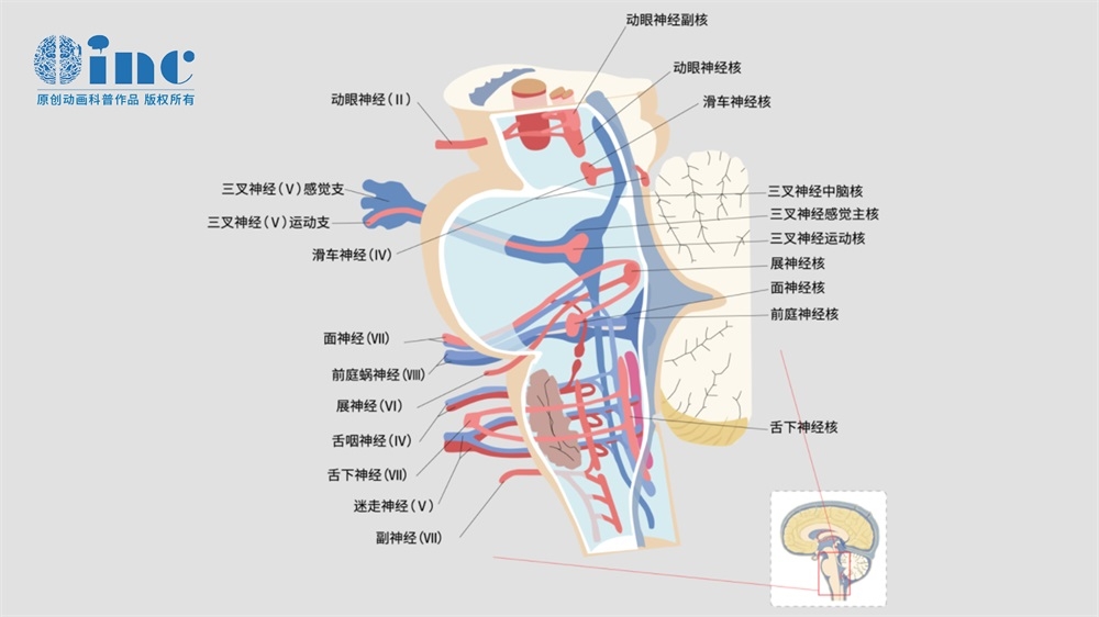 腦干海綿狀血管瘤
