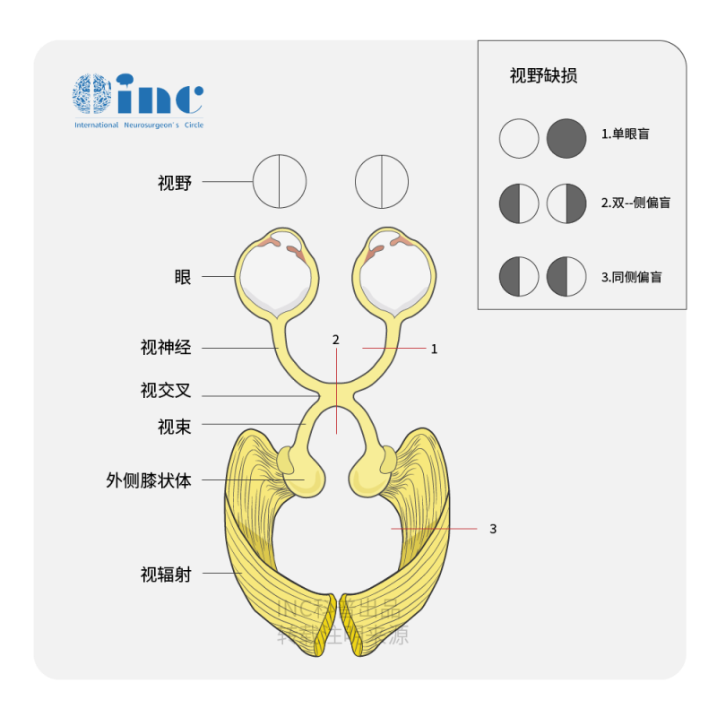 視神經(jīng)膠質(zhì)瘤