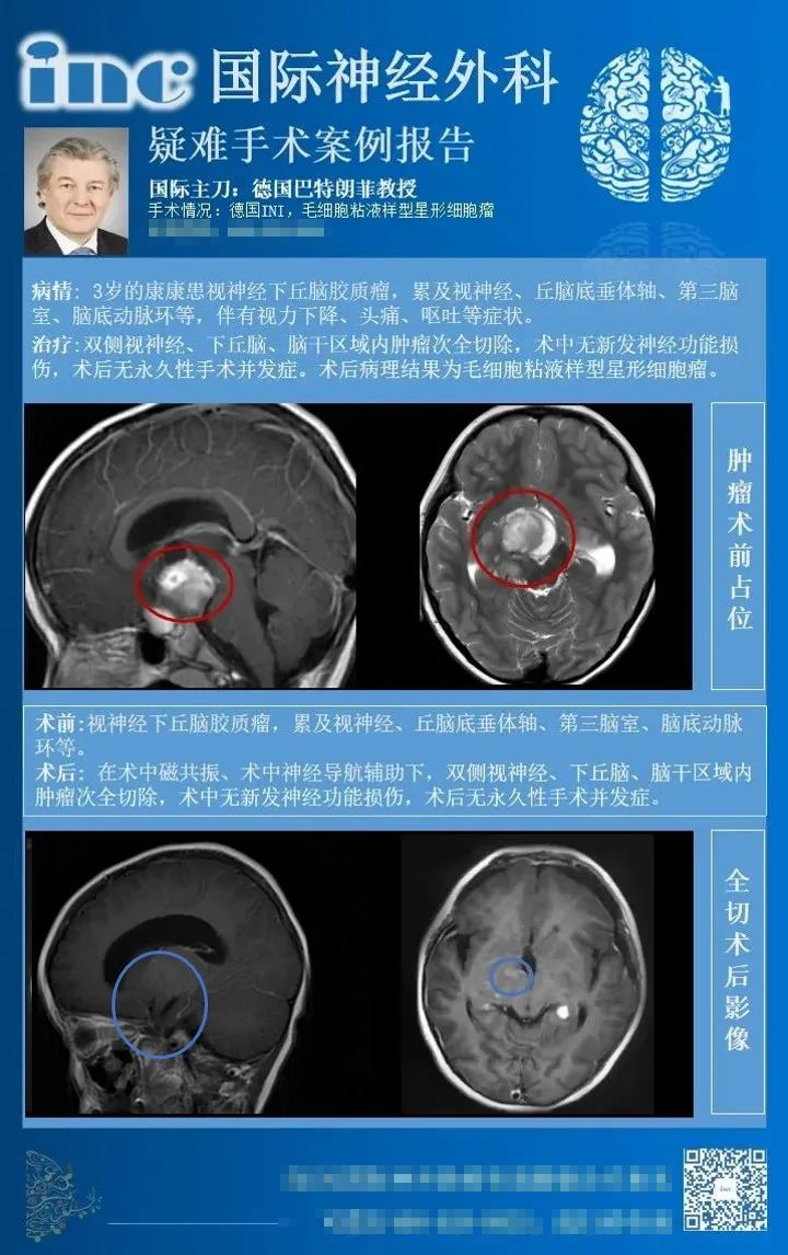 視神經(jīng)膠質(zhì)瘤