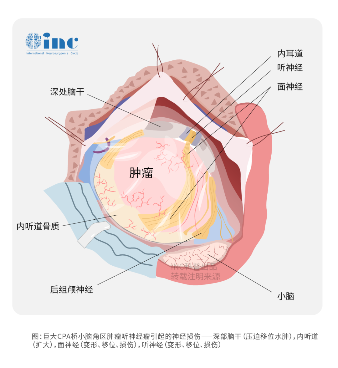 cpa腦膜瘤