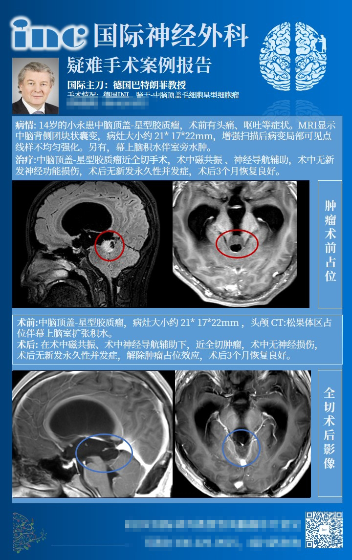 星形細胞瘤治療方法-2