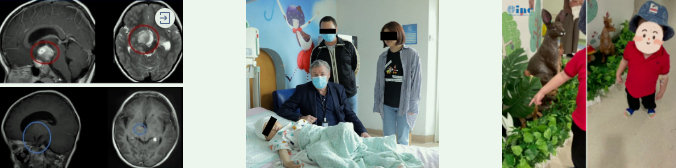 INC成功手術(shù)案例之較大視路膠質(zhì)瘤“等待失明”，還是奮力一搏？