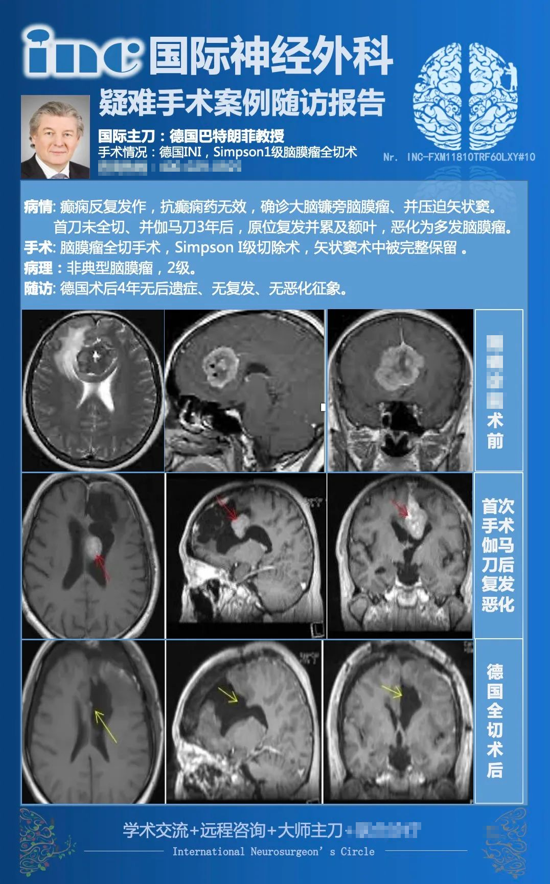 腦膜瘤放療