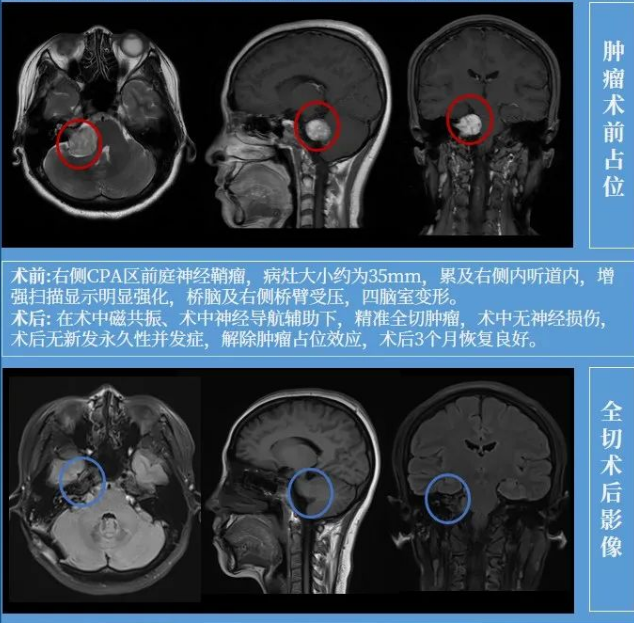 聽神經(jīng)瘤手術(shù)患者自述
