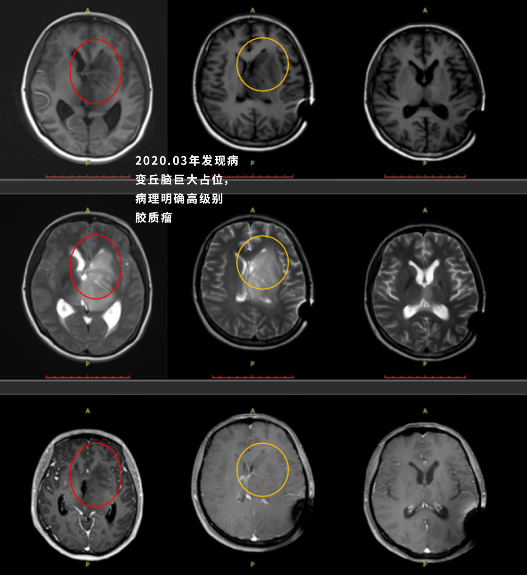 丘腦腫瘤