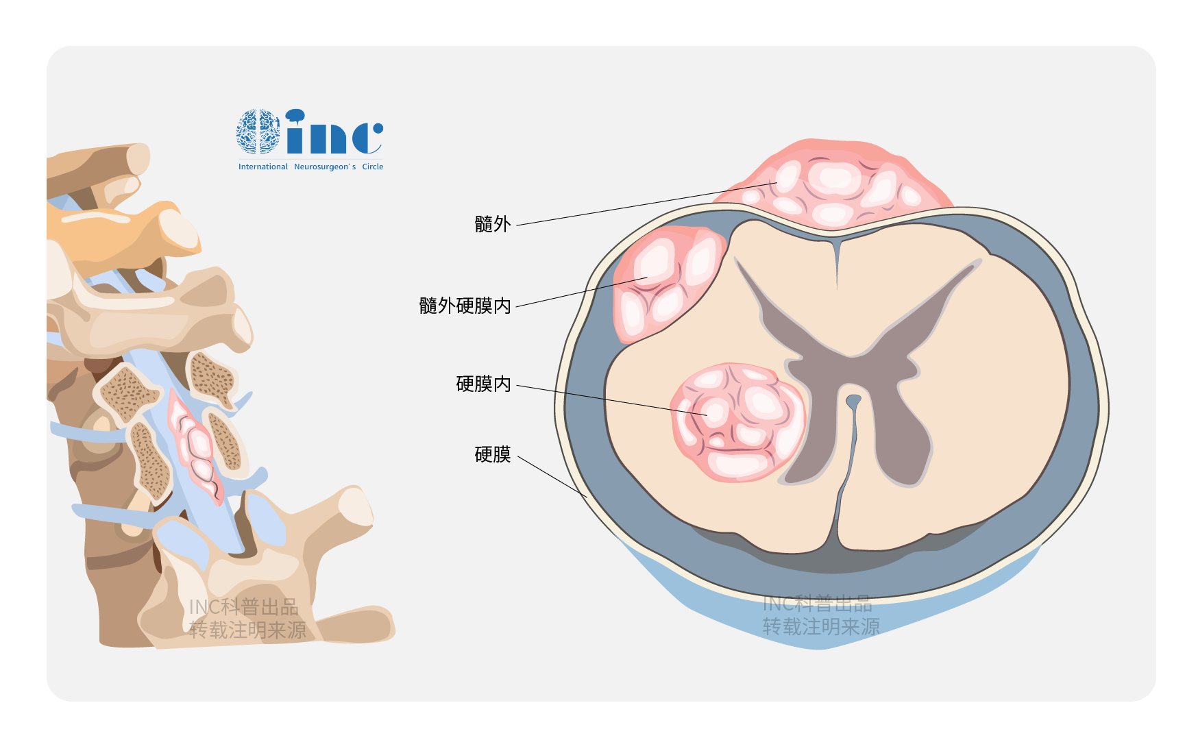 脊髓髓內(nèi)腫瘤復(fù)發(fā)