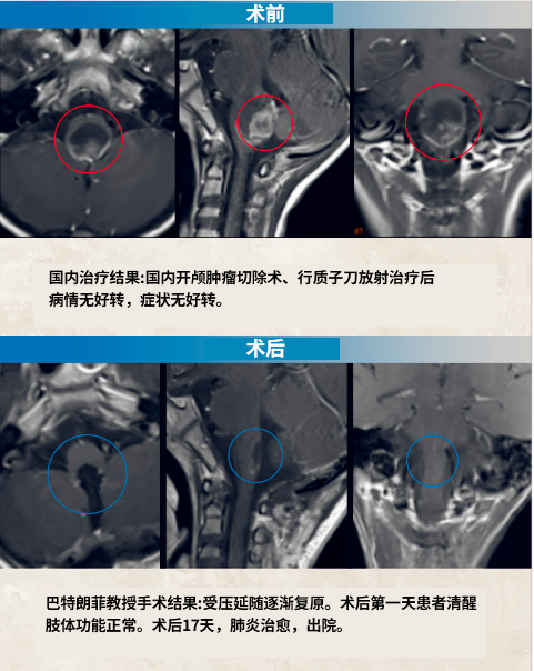 四腦室腫瘤