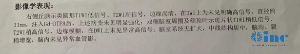 丘腦腫瘤手術(shù)