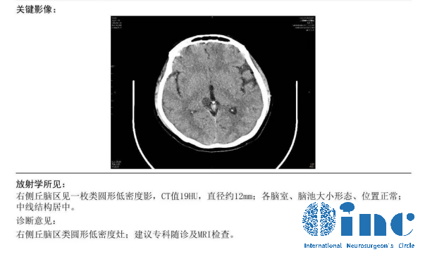 丘<a href='/naoliu/' target='_blank'><u>腦腫瘤</u></a>