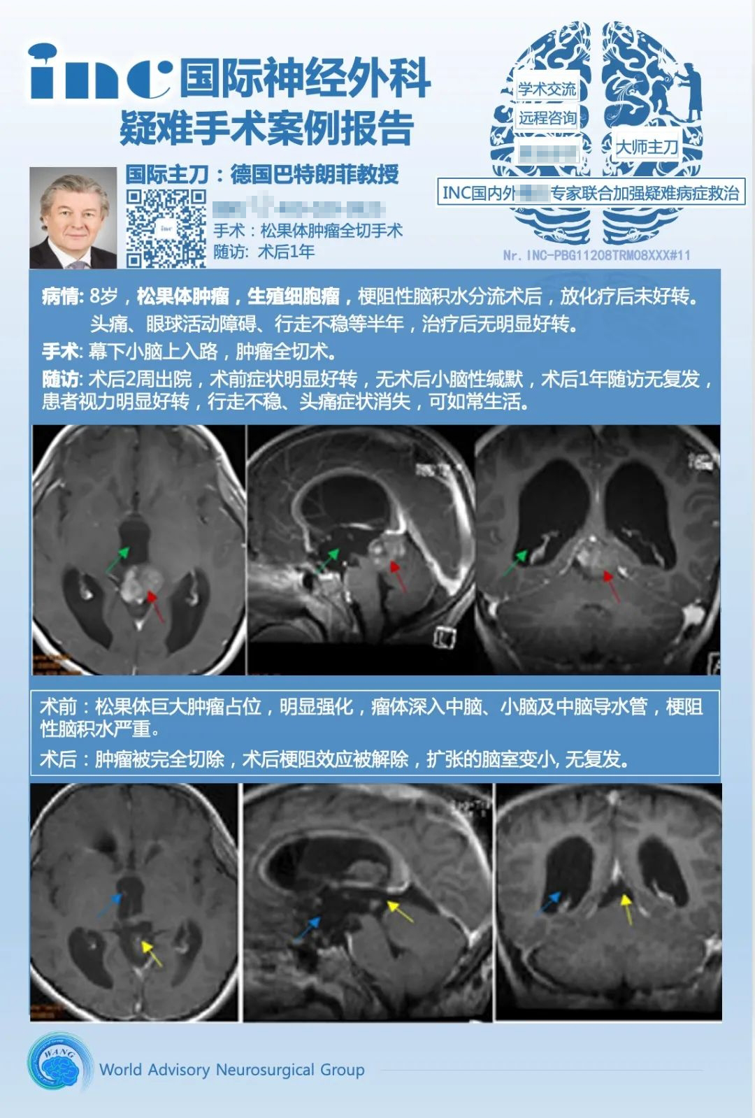 松果體生殖細胞瘤