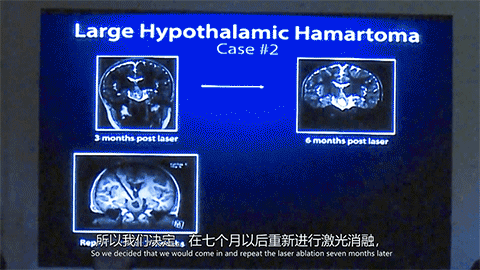 癡笑樣癲癇