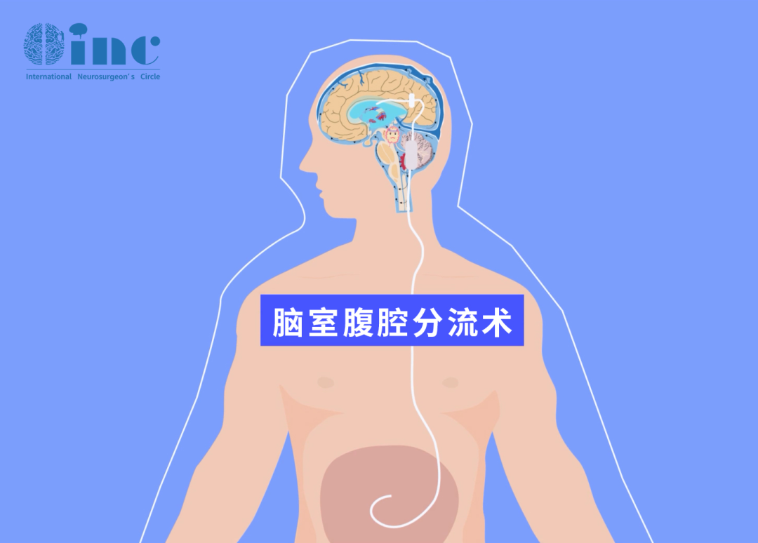 兒童腦積水腦室－腹腔分流術(shù)后，可能出現(xiàn)哪些問題？