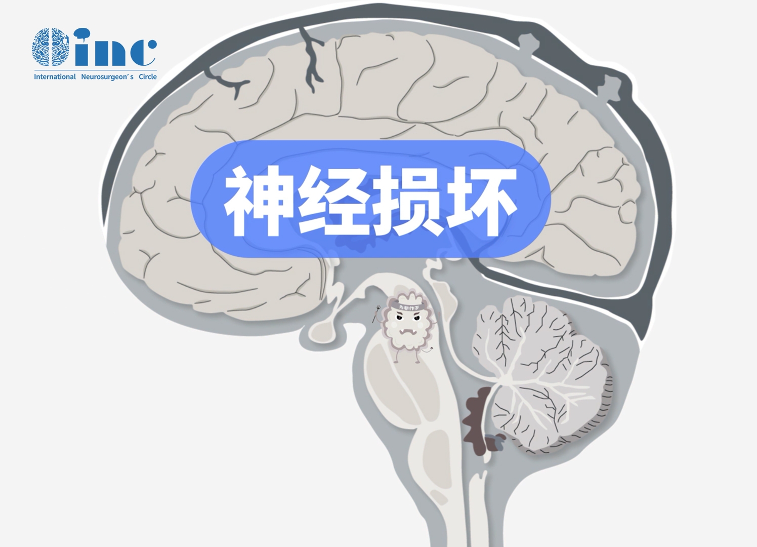 腦干<a href='/jiaozhiliu/' target='_blank'><u>膠質(zhì)瘤</u></a>手術(shù)