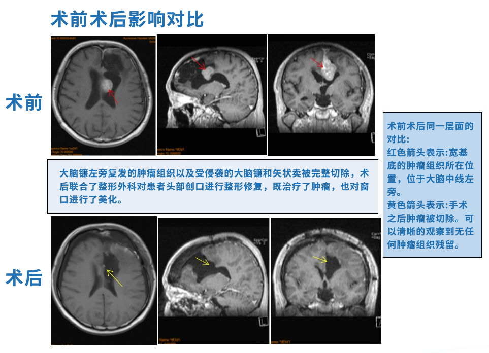 多發(fā)腦膜瘤