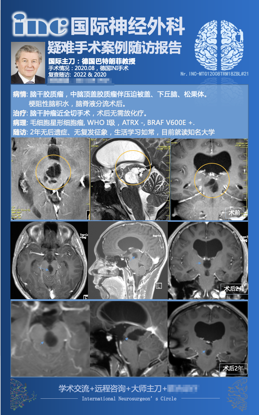 巴教授中腦頂蓋膠質(zhì)瘤