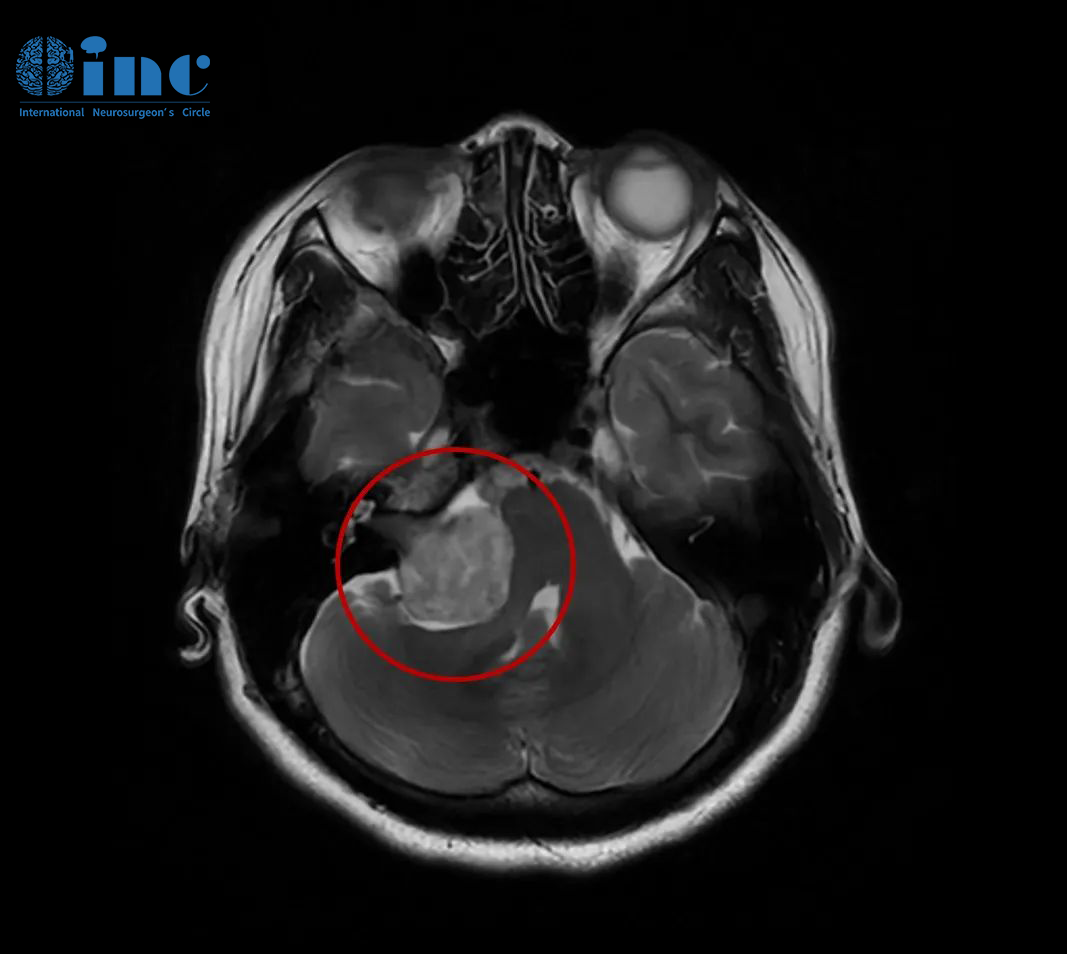<a data-cke-saved-href='/tingshenjingliu/' href='/tingshenjingliu/' target='_blank'><u>聽(tīng)神經(jīng)瘤</u></a>
