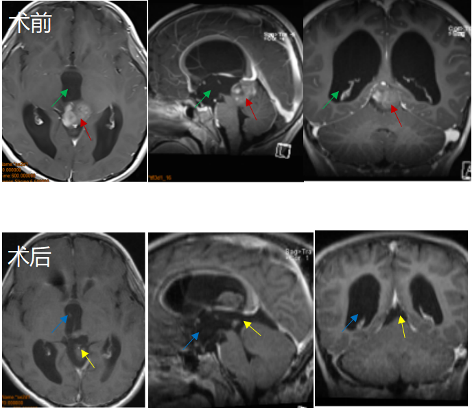 <a href='/songguotiliu/' target='_blank'><u>松果體腫瘤</u></a>案例