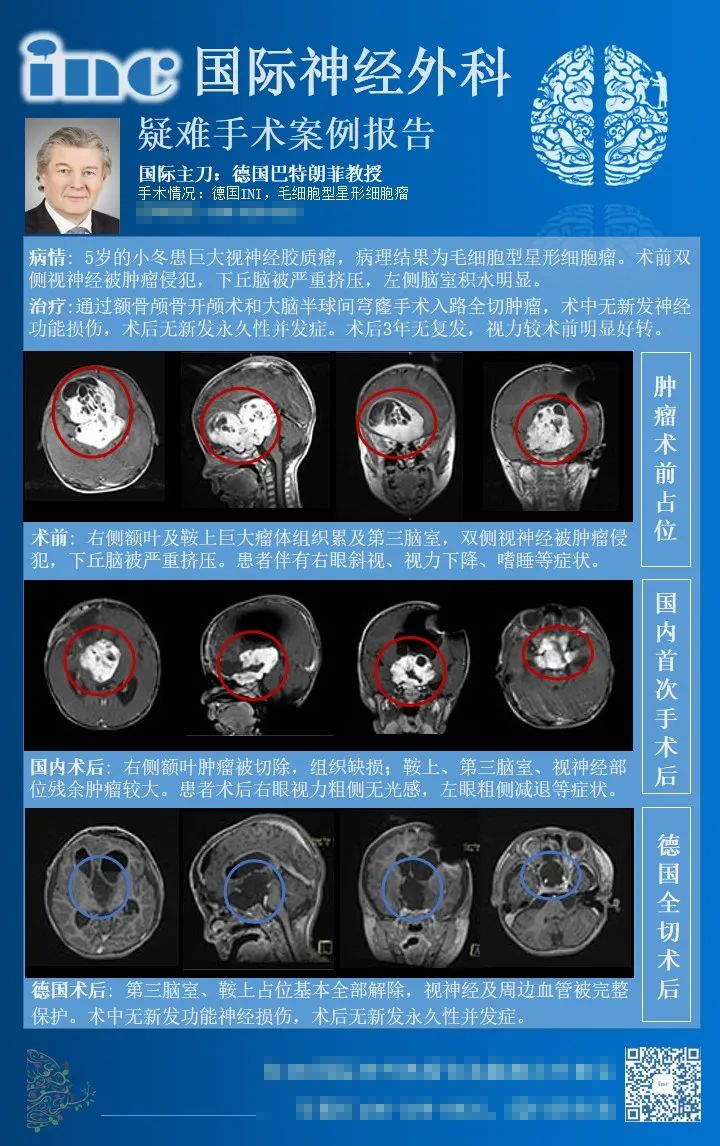 視神經(jīng)膠質(zhì)瘤