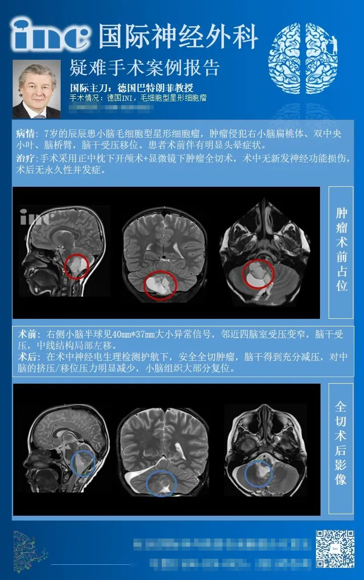 腦干膠質(zhì)瘤