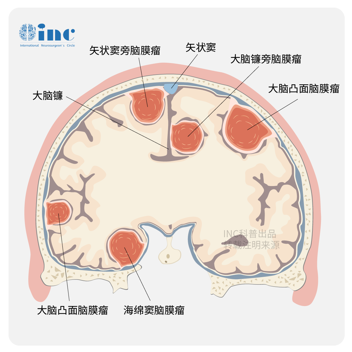 腦膜瘤