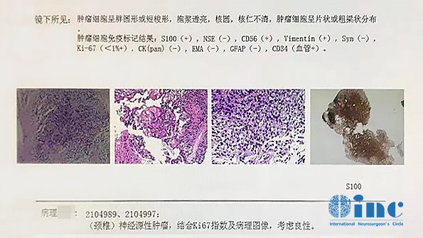 脊髓髓內(nèi)腫瘤術后病理分析