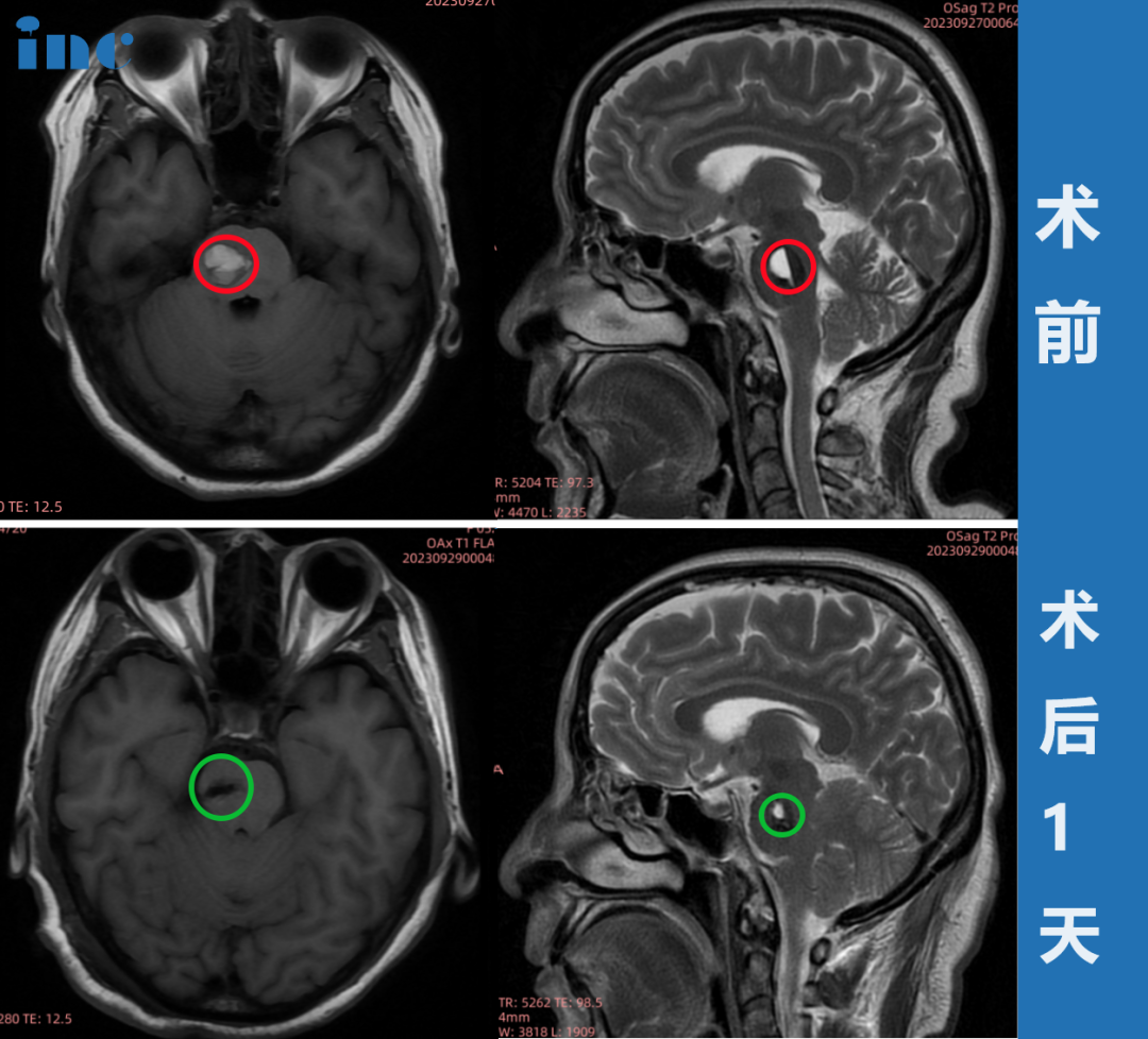 腦干-腦橋海綿狀血管瘤