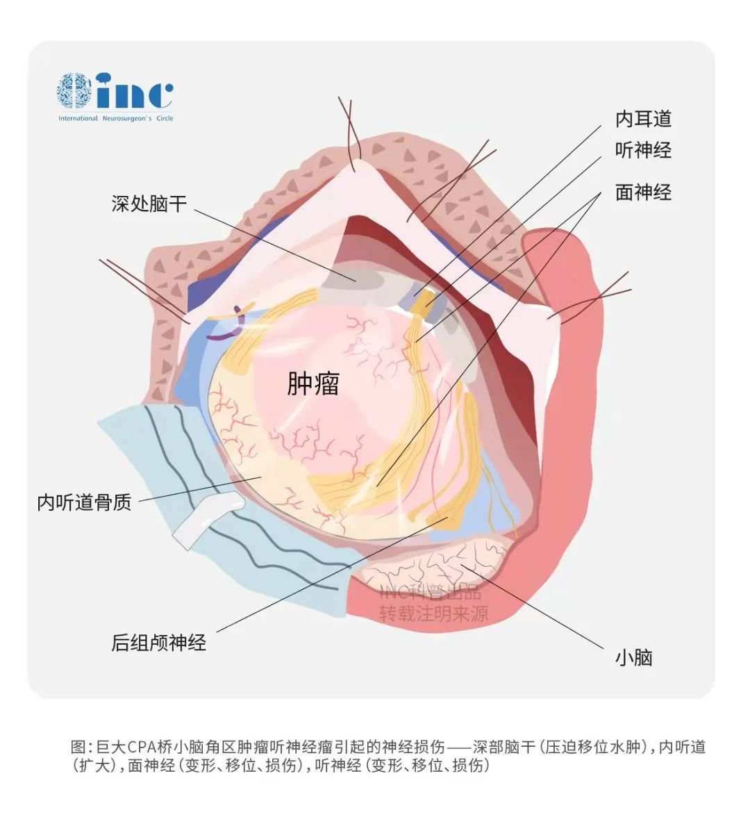 聽(tīng)神經(jīng)瘤