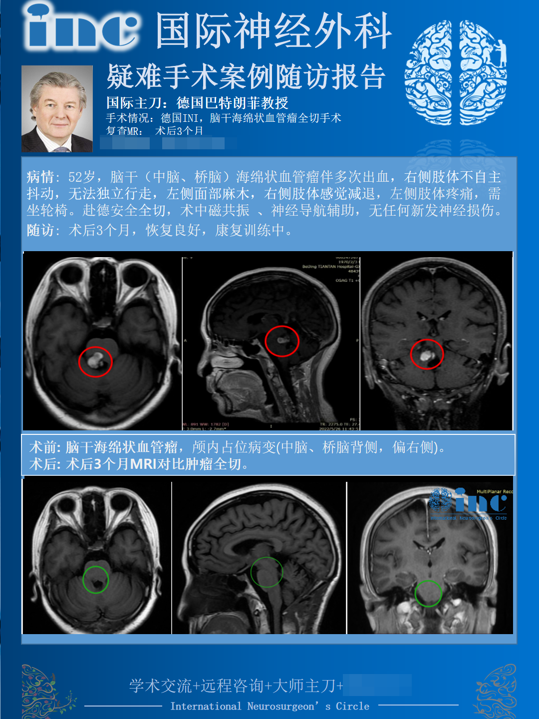 腦干海綿狀血管瘤,巴特朗菲教授