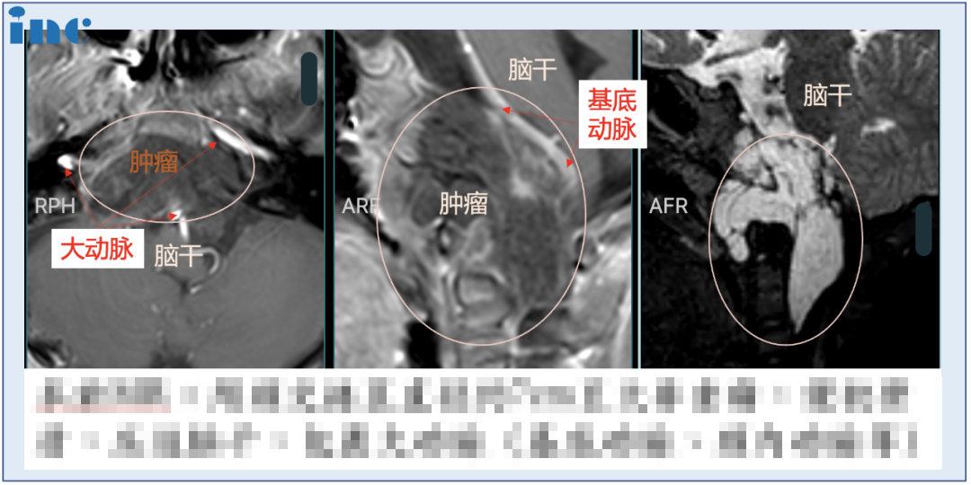 年齡小、體重低、腫瘤大怎么辦？INC福洛里希教授8mm切口“筷子＂神經(jīng)內(nèi)鏡手術(shù)破局較大顱底脊索瘤