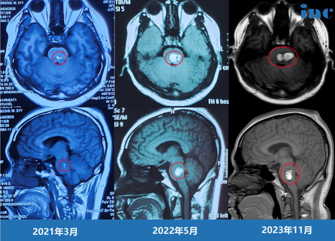 33歲男性-腦干(橋腦)海綿狀血管瘤3次出血