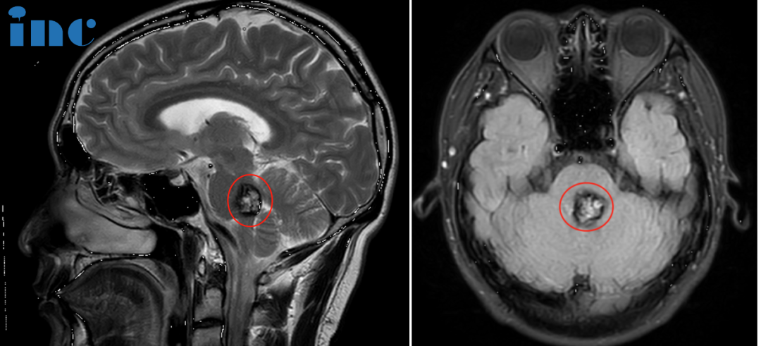 腦干海綿狀血管瘤術(shù)前MRI