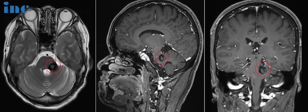 腦干海綿狀血管瘤術(shù)前MRI