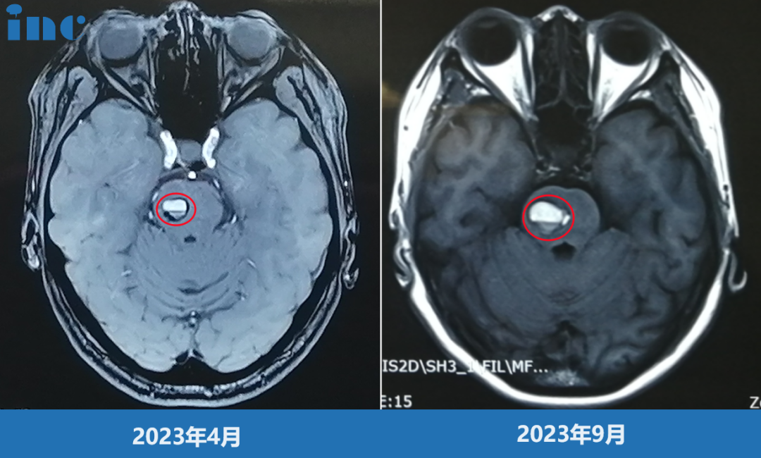 腦干海綿狀血管瘤影像