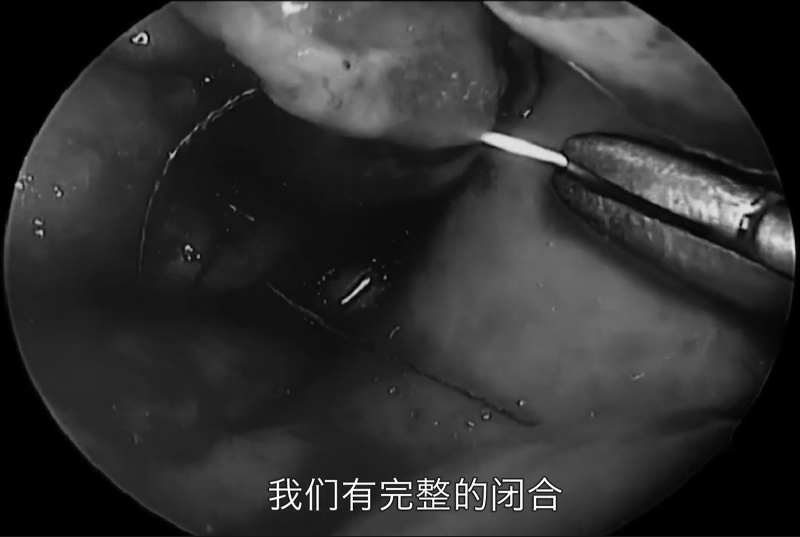 不開顱從鼻孔1cm切口竟就可以取出較大腦瘤